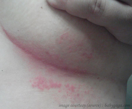 Rash : Check Your Symptoms and Signs – MedicineNet