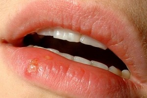 How Does Oral Herpes Transmission Occur?