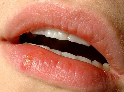 How Does Oral Herpes Transmission Occur?