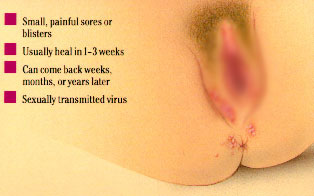 genital herpes