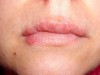 What Triggers Cold Sores to Break Out?