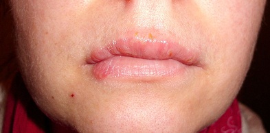 oral herpes symptom